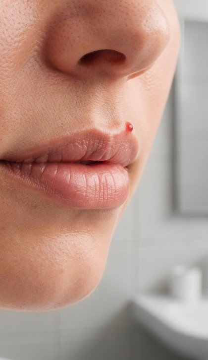 a zit on my lip a zit on my lip